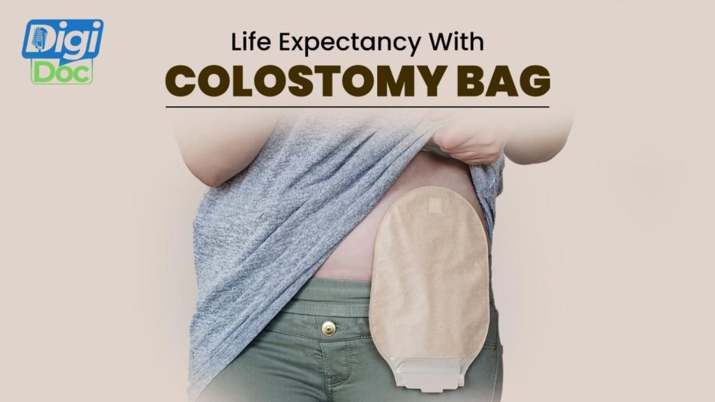 life-expectancy-with-colostomy-bag